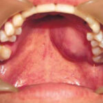 How to Identify and Treat Swelling of the Roof of the Mouth