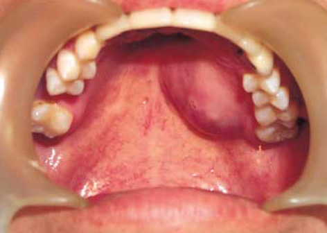 How to Identify and Treat Swelling of the Roof of the Mouth